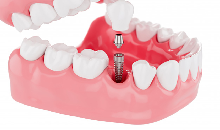 Trồng răng implant được thực hiện độc lập, không xâm lấn đến răng thật