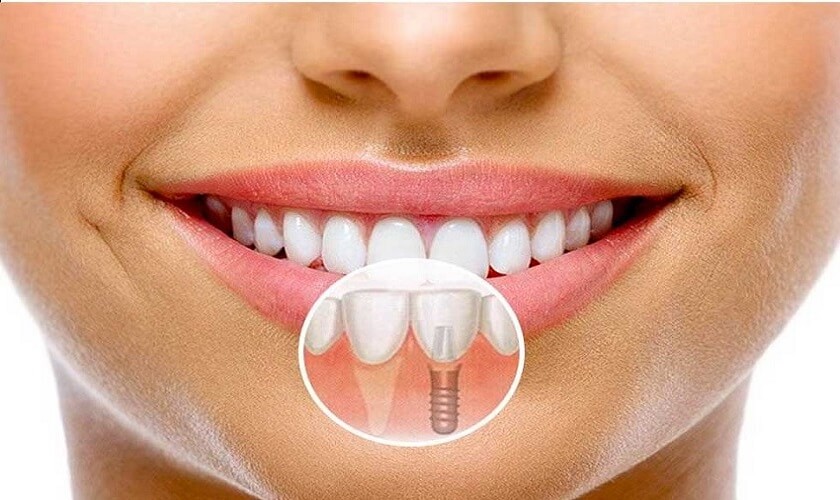 Răng implant mang đến hàm răng hoàn hảo cho các khách hàng