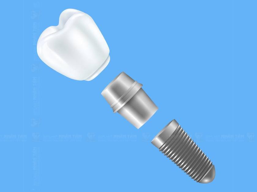 Straumann Implant SLA là dòng Implant đời đầu với thiết kế truyền thống