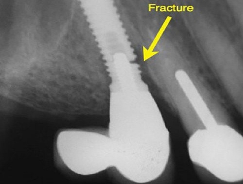 Gãy trụ Implant dẫn đến lung lay chân răng giả