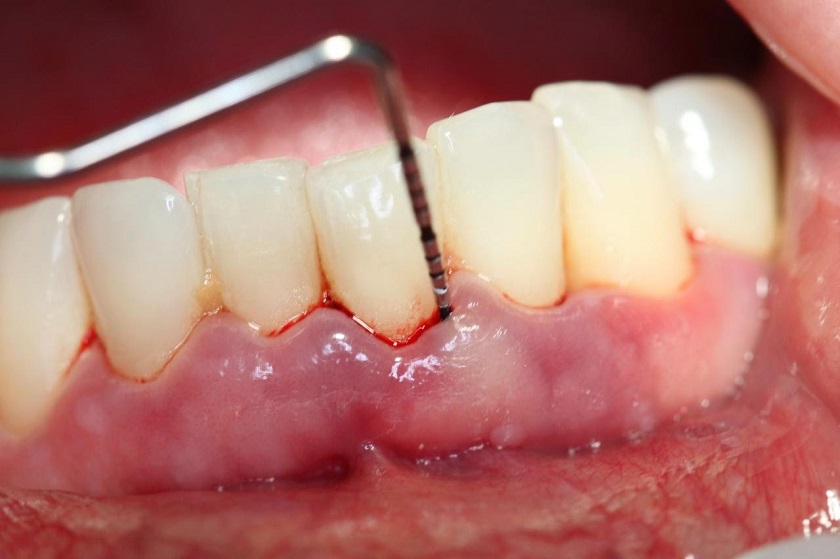 Sưng mọng răng không được điều trị dễ gây ra viêm chân răng