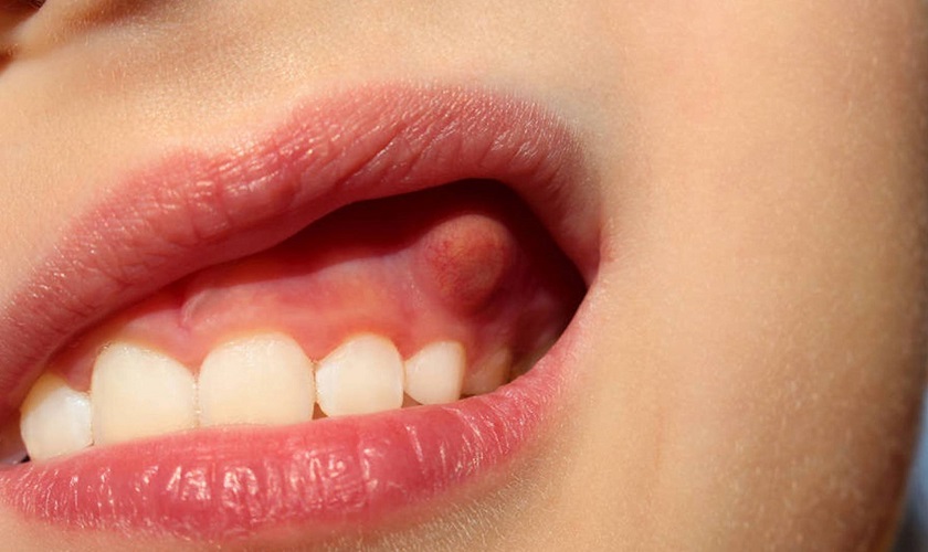 7 Cách chữa sưng mộng răng tại nhà mà bạn nên biết