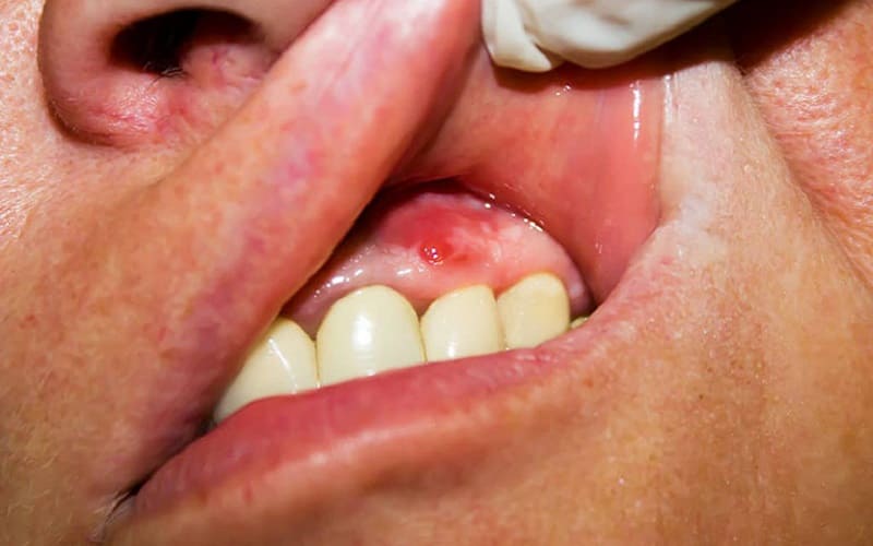 Áp xe răng là gì? Phải làm gì khi bị áp xe răng?