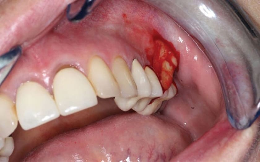 Áp xe răng là tình trạng nướu bị sưng tấy, đau nhức kèm theo chảy mủ hoặc tích tụ mủ