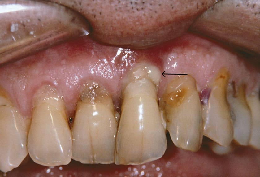 Do viêm nha chu nặng có thể dẫn đến áp xe răng