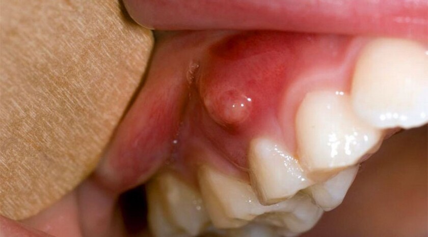 Áp xe chân răng có thể gây nguy hiểm đến tính mạng người bệnh