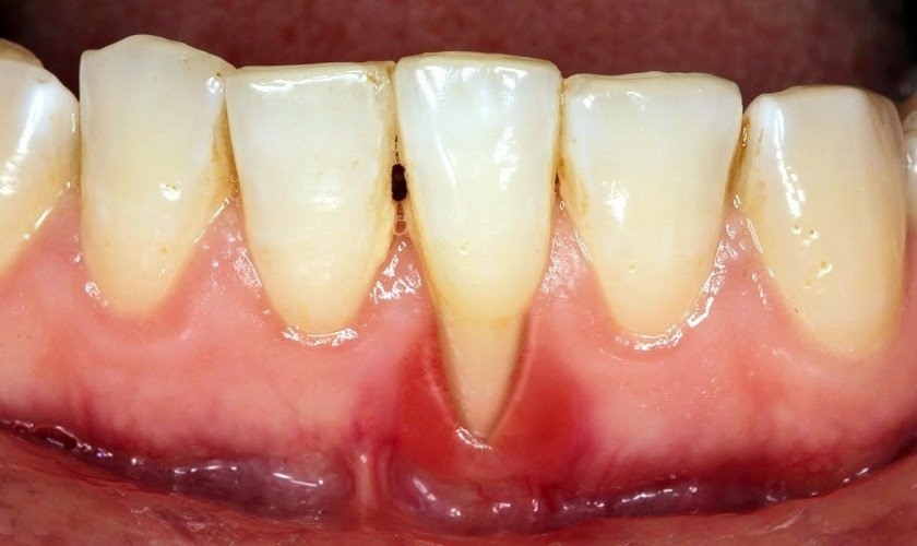 Bị hở chân răng phải làm sao? Đâu là cách điều trị hiệu quả?