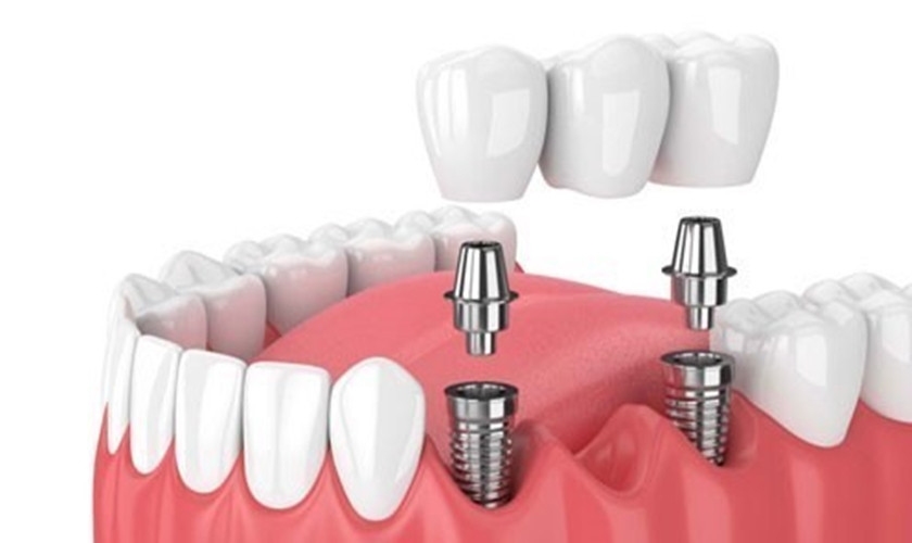 Cấy ghép Implant phương pháp trồng răng hiện đại nhất hiện nay