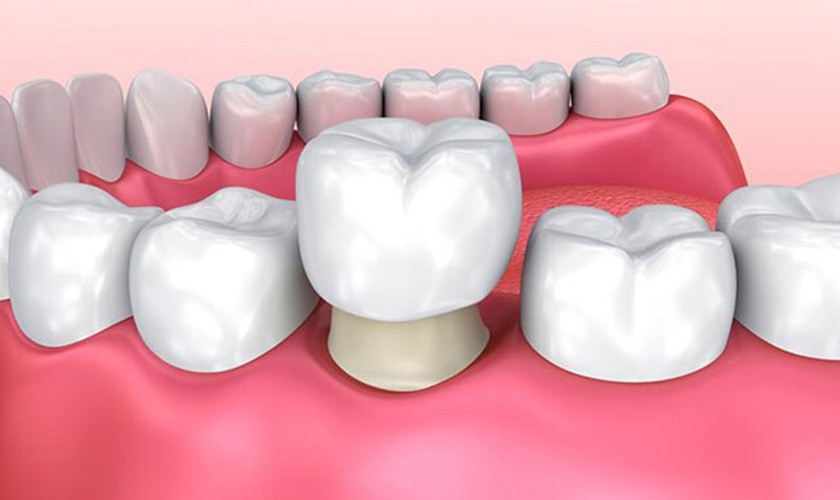 Cầu răng sứ phương pháp được nhiều khách hàng tin cậy