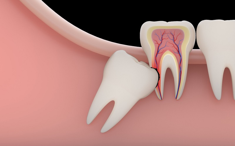 Các cách giảm đau răng khôn hiệu quả nhất 2023