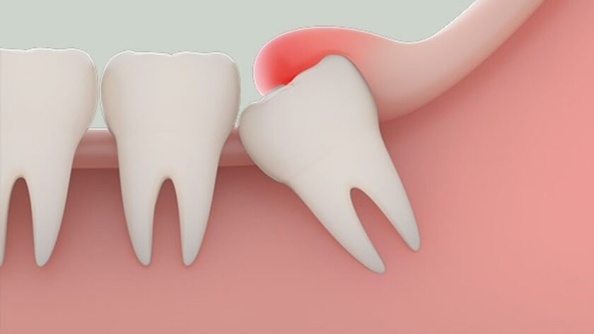 Răng khôn mọc thường đâm vào nướu và gây đau nhức trong vài ngày