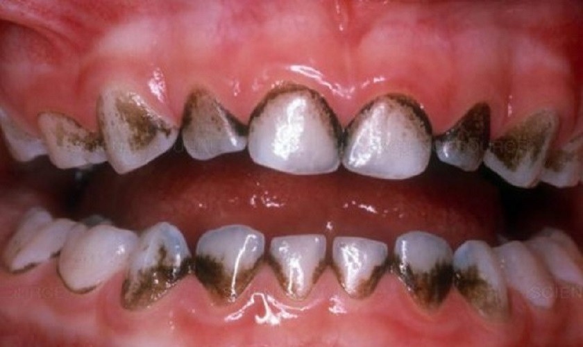 Cách trị kẽ răng bị đen tại nhà hiệu quả