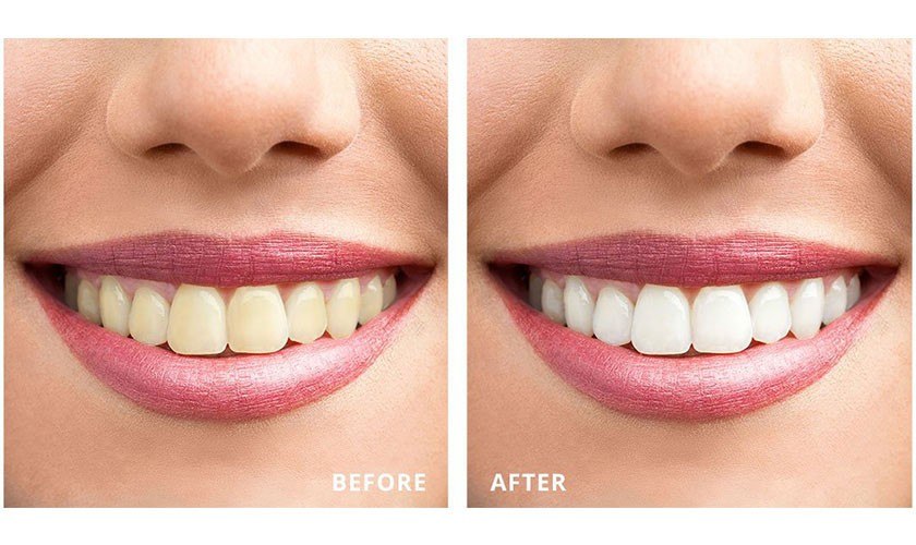 Tẩy trắng răng giải pháp được sử dụng phổ biến giúp răng trắng sáng
