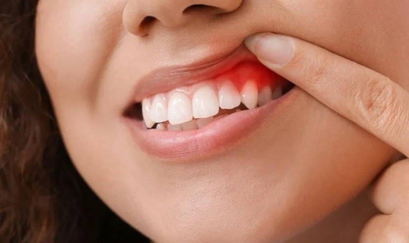 Bật mí cách trị sưng nướu răng trong cùng tại nhà hiệu quả