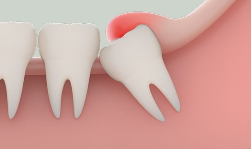 Mọc răng khôn nguyên nhân phổ biến gây sưng nướu răng