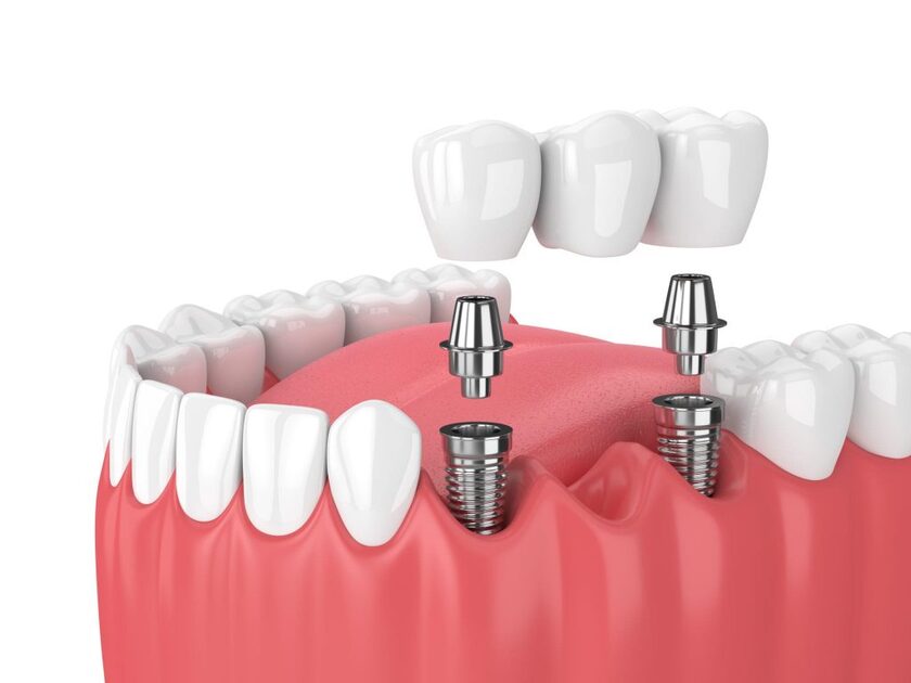Nếu mất từ 3 răng liền kề trở lên có thể phục hình bằng cầu răng sứ trên Implant