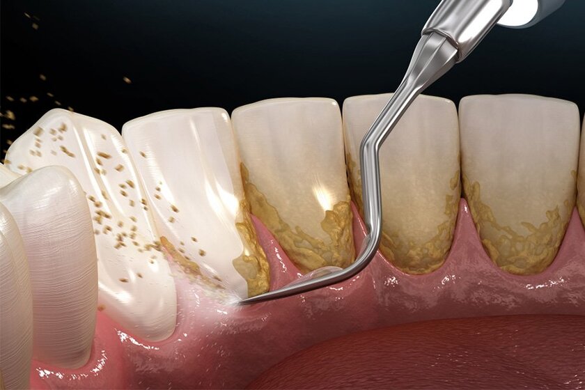 Bạn nên đến khám và lấy vôi răng định kỳ tại các phòng khám nha khoa uy tín