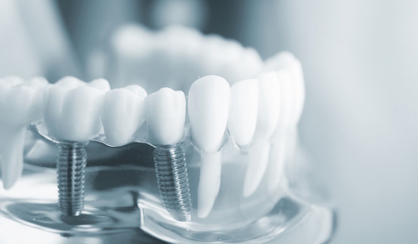 Số lượng răng implant là yếu tố ảnh hưởng đến mức độ đau