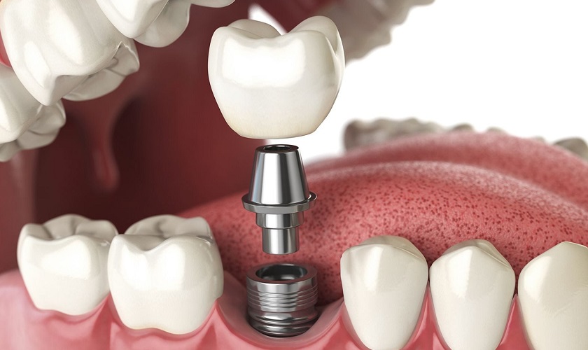 Cấy răng Implant có đau không? Implant Infor