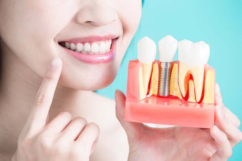 Chăm sóc răng implant đúng cách giúp kéo dài tuổi thọ của răng implant