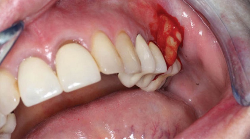 Các bệnh lý răng miệng chưa điều trị dứt điểm trước khi cấy implant dễ dẫn đến tình trạng chảy máu