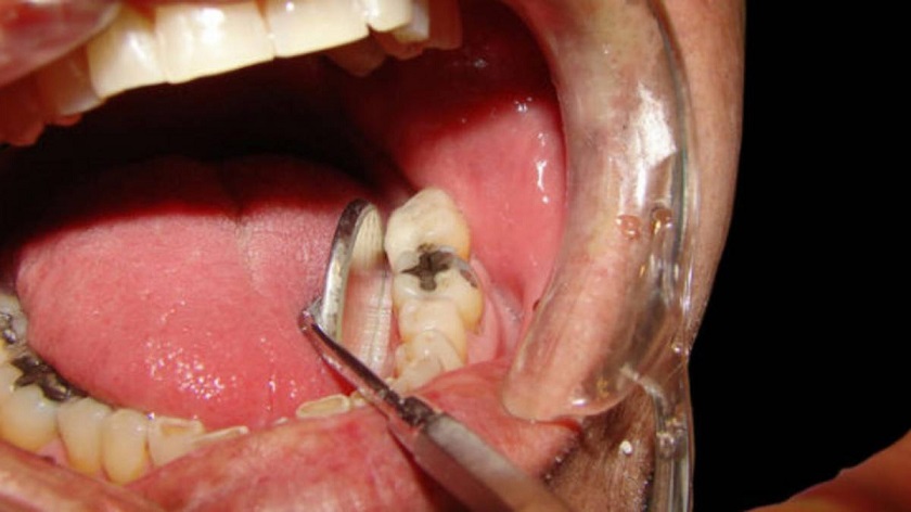 Viêm tủy răng gây ra tình trạng đau nhức răng<