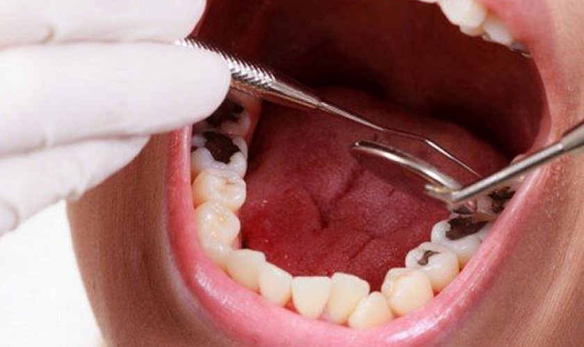 Có nên bọc răng sứ cho răng bị sâu không?