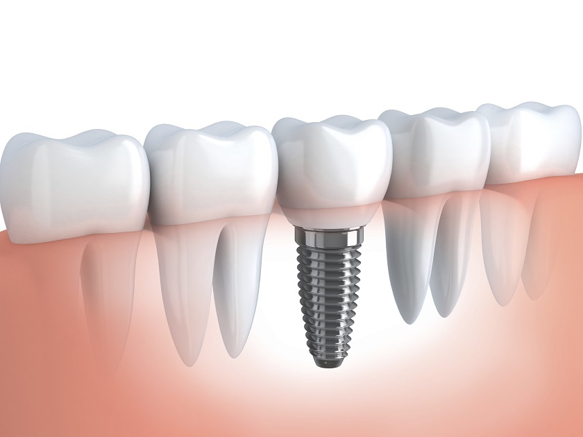 Phương pháp trồng răng implant