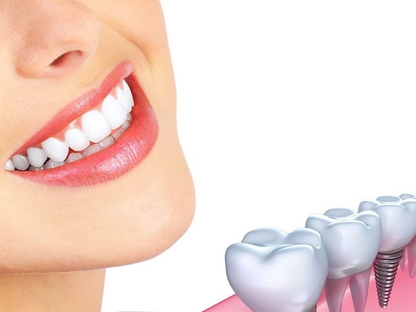 Cấy ghép implant mang lại nhiều lợi ích cho người mất răng