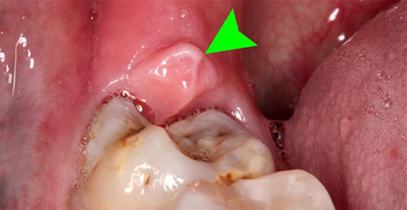 Các vấn đề răng miệng cũng có thể gây cứng hàm