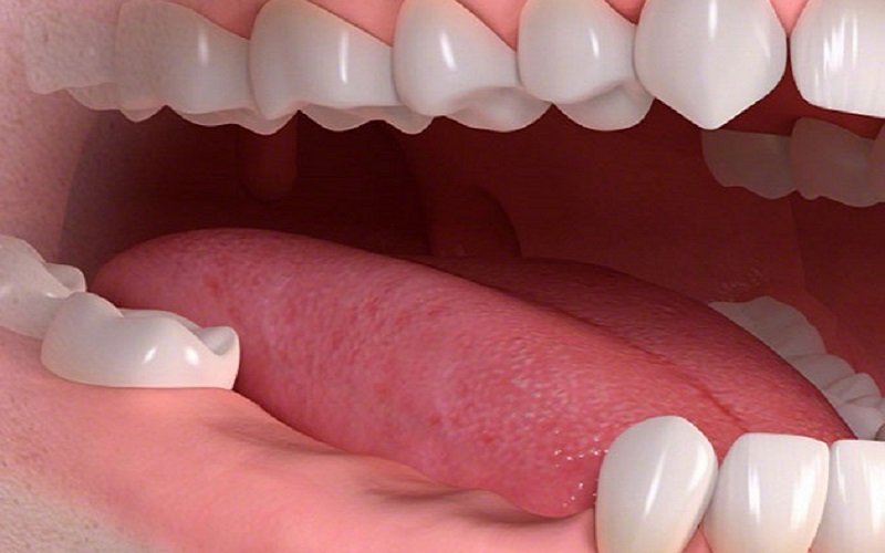Gãy răng hàm có nguy hiểm không? Phải làm gì khi bị gãy?