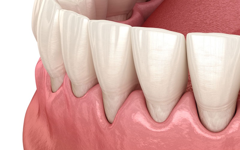 Ghép nướu trong phục hình răng bằng cấy ghép Implant