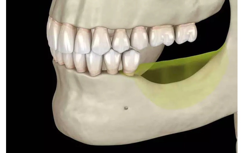 Mất răng lâu năm dẫn đến tiêu xương hàm