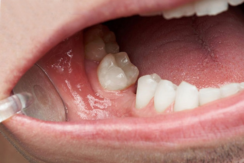 Răng bị xô lệch về hường răng bị mất