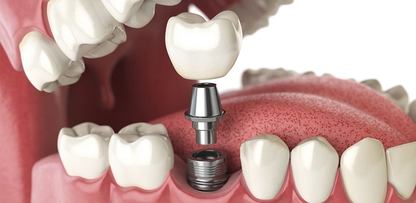 Cấy ghép implant cho người bị mất răng lâu năm