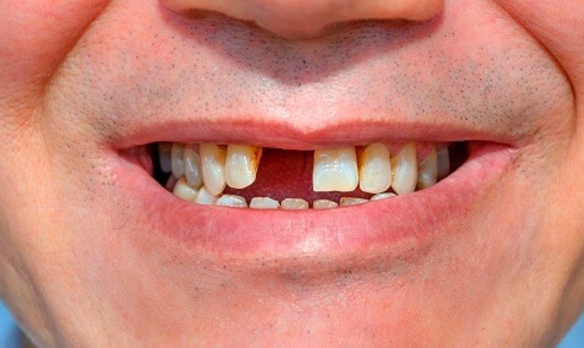Hậu quả khôn lường từ mất răng vĩnh viễn