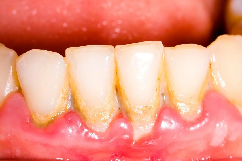 Ngà răng lộ ra ngoài, răng dài hơn bình thường