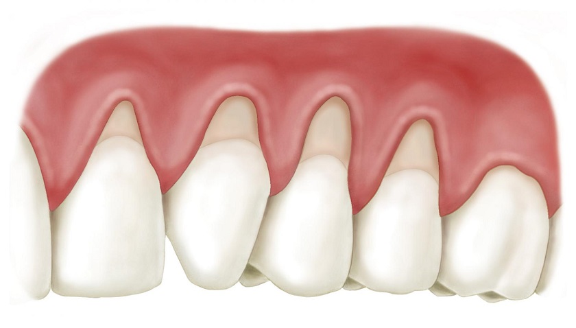 Tình trạng tụt lợi gây chảy máu trong khi ăn uống hay đánh răng