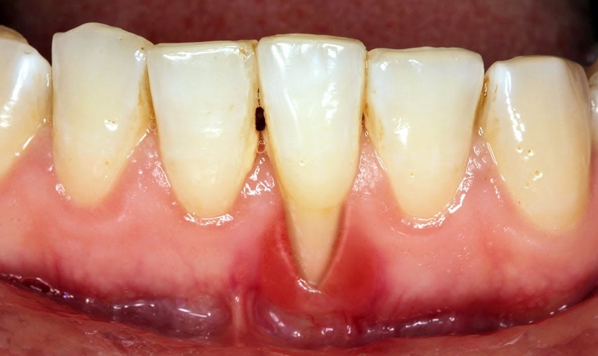 Hở chân răng: Nguyên nhân và cách điều trị