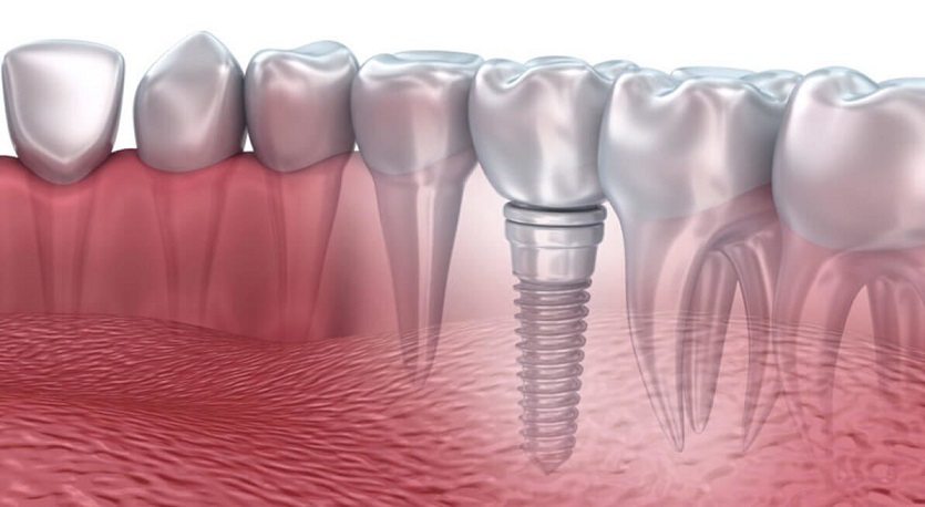 Phục hình răng hiệu quả với phương pháp cấy ghép implant