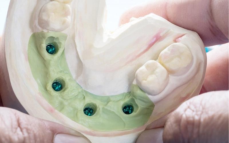 Lấy dấu răng Implant là gì? Quan trọng thế nào?