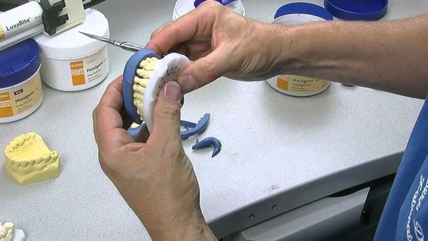 Sử dụng thạch cao lấy dấu răng là phương pháp thủ công đã có từ lâu đời