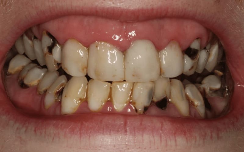 Mục răng: Nguyên nhân, dấu hiệu và cách điều trị