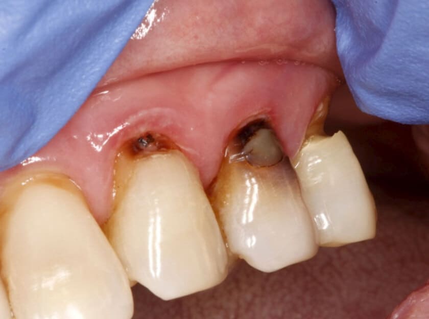 Mục răng được coi là một tình trạng sâu răng rất nghiêm trọng