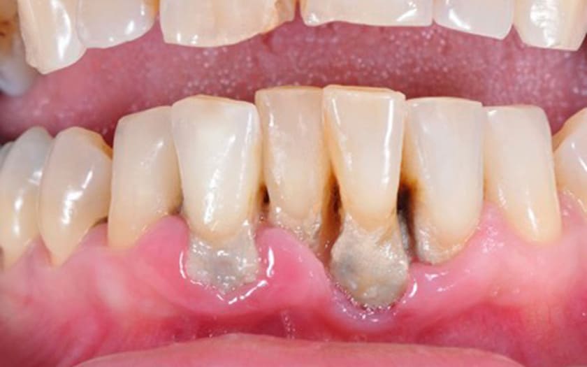 Có nhiều cao răng tích tụ có thể dẫn đến tình trạng mòn chân răng khiến răng yếu đi