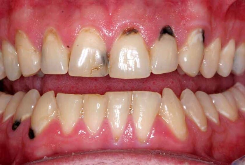 Tình trạng răng bị mục thường xuất hiện trên bề mặt của chiếc răng bị tổn thương