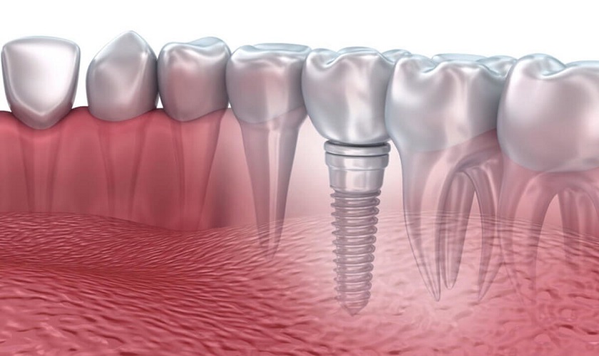 Người cao huyết áp có thể trồng răng Implant được không?