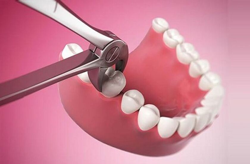 Nhổ răng là thủ thuật nha khoa cuối cùng được bác sĩ chỉ định khi răng không còn cách nào bảo tồn được