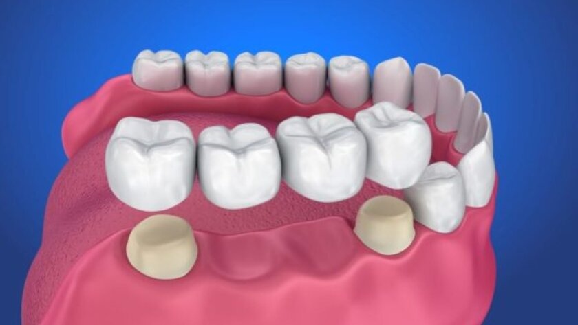 Phương pháp làm cầu răng sứ áp dụng cho trường hợp mất 1 răng hoặc nhiều răng
