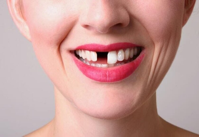 Mất thẩm mỹ là hậu quả đầu tiên đối với bất kỳ ai bị mất răng